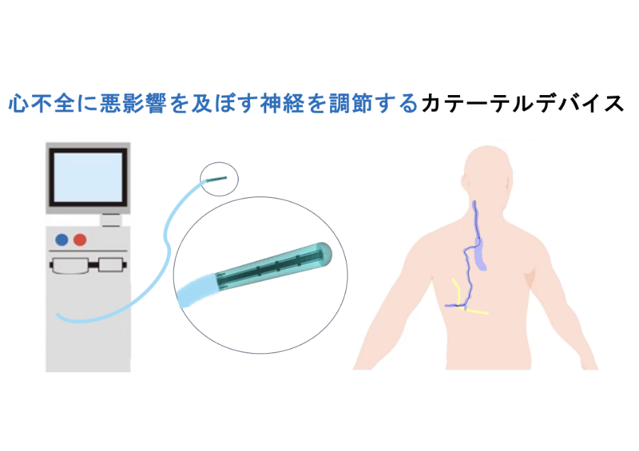 心不全の新規治療デバイスの開発