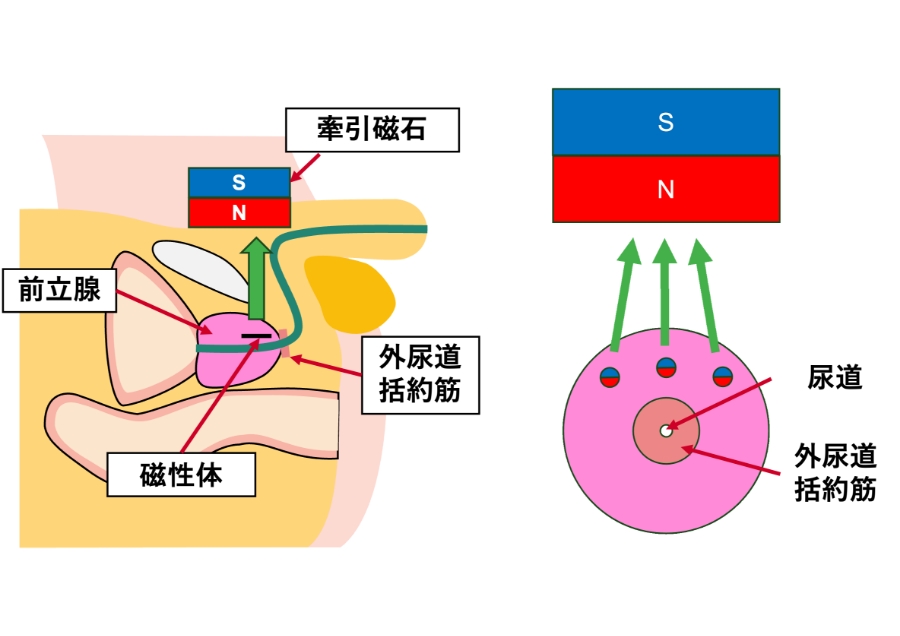 脊髄損傷による排尿障害のための磁力尿路拡張デバイス